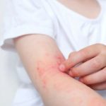 Узнайте, как отличить укус клопа, чем лечить поражение и как быстро снять покраснение после укуса. Практические советы для безопасного и эффективного ухода.